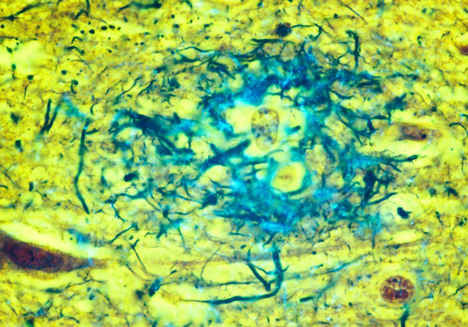 Diseased brain tissue from an Alzheimer's patient showing amyloid plaques (in blue) located in the gray matter of the brain.