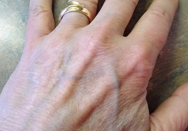 Bill Tammeus' left hand